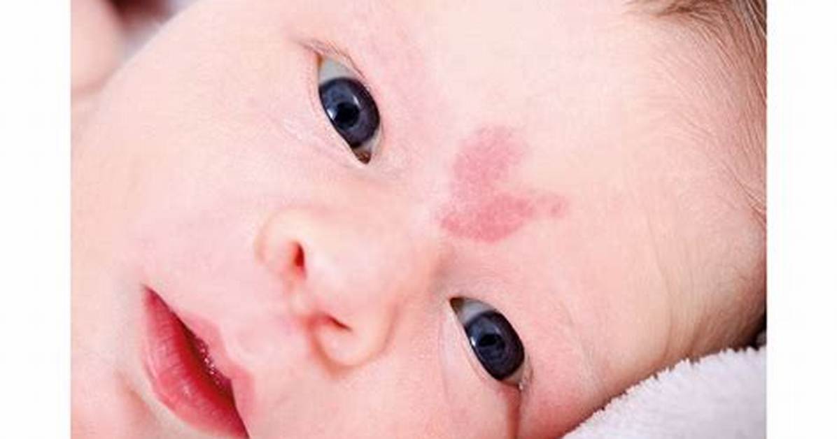 Is a Stork Bite Really a Warning Sign of Mthfr Mutation? Viral Panic Debunked