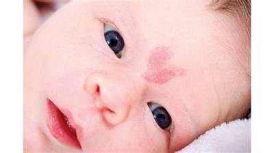 Is a Stork Bite Really a Warning Sign of Mthfr Mutation? Viral Panic Debunked