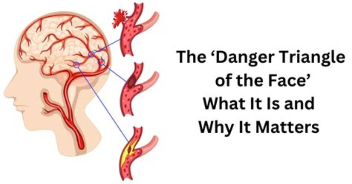 Mapping the Danger Triangle: Visual Medical Evidence Behind the Nose Infection Panic